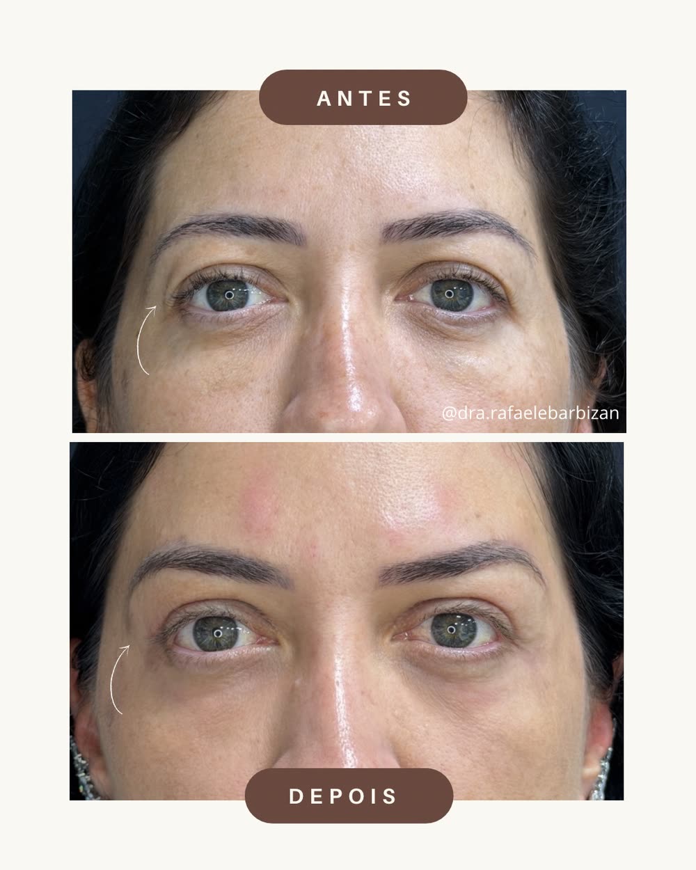 Resultado de blefaroplastia realizada pela Dra. Rafaele Barbizan Garofolo